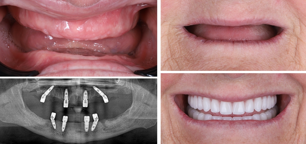 all-on-4 dental implant x-ray