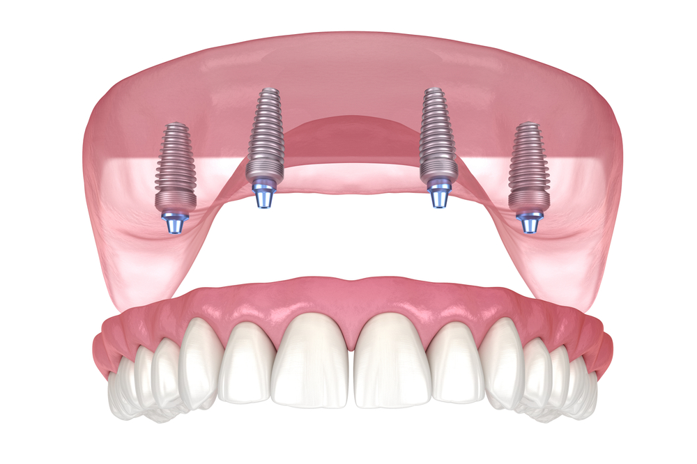 implant supported denture