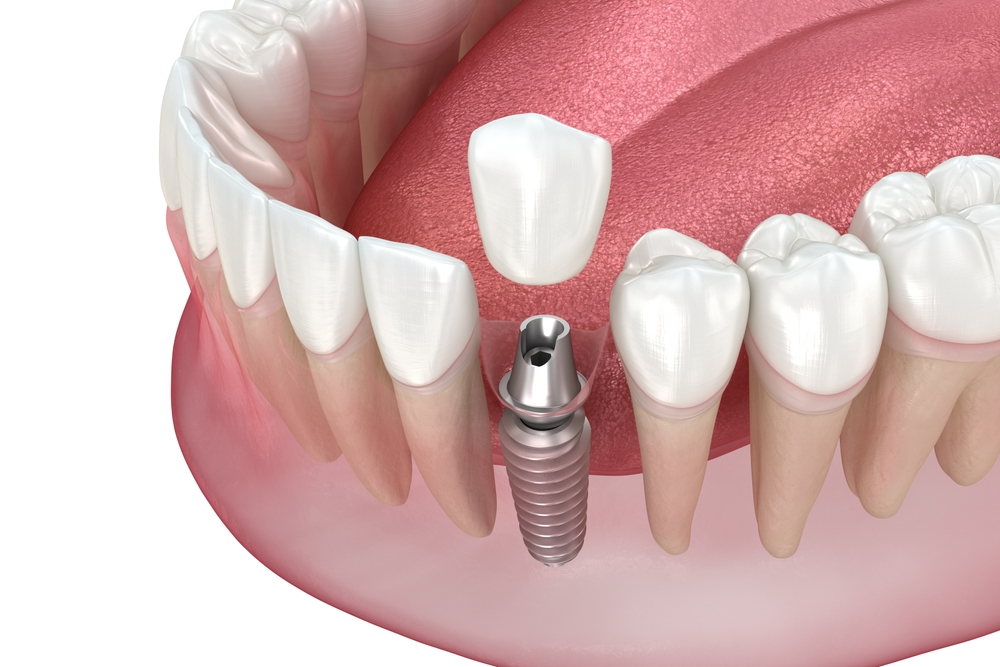 dental implant