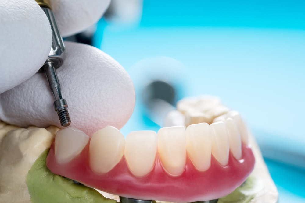 implant supported denture
