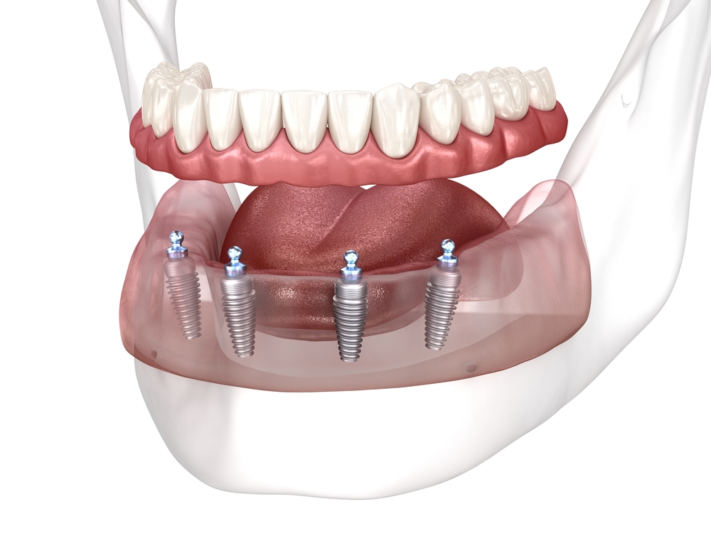 all on 4 dental implants