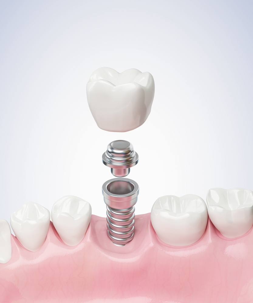 single tooth dental implant