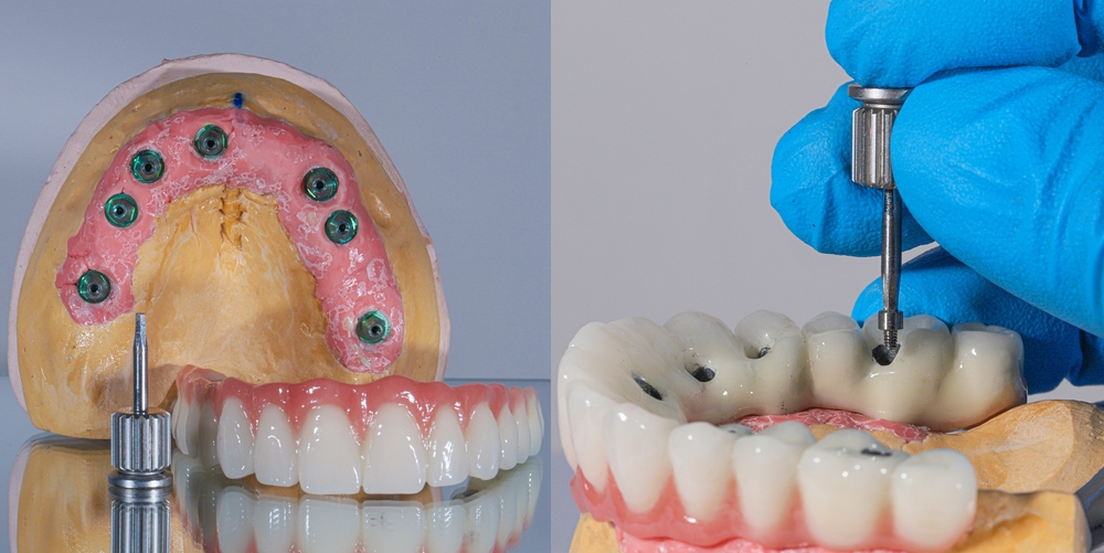 dental implant treatment model